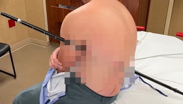ABŞ-də dağda bədəninə çubuq batmış turist təkbaşına eniş edib - FOTO