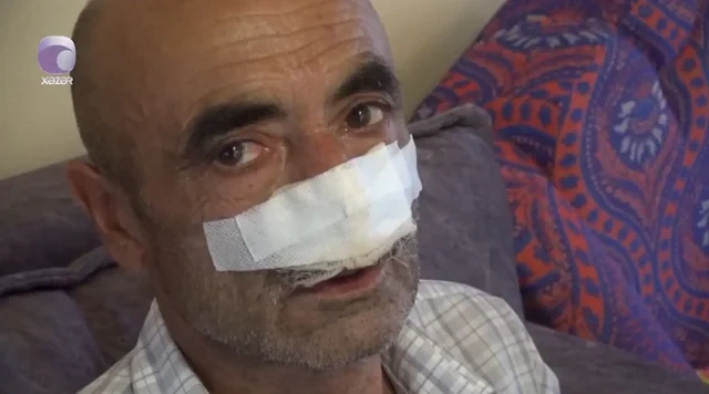 İt burnunu dişlədi, müalicə olunmasa çürüyəcək - VİDEO