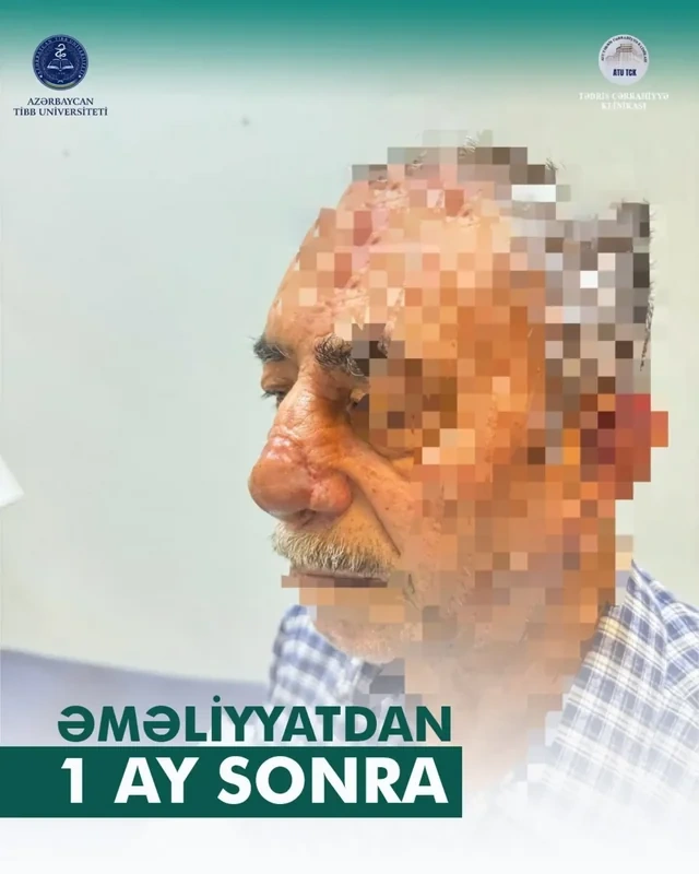 İt dişləməsi nəticəsində burnunu itirən xəstəyə yeni burun formalaşdırıldı - Azərbaycanda unikal əməliyyat - VİDEO - FOTO