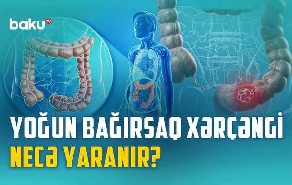 Yoğun bağırsaq xərçənginin qarşısını necə almaq olar? - VİDEO