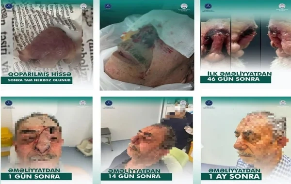 İt dişləməsi nəticəsində burnunu itirən xəstəyə yeni burun formalaşdırıldı - Azərbaycanda unikal əməliyyat - VİDEO - FOTO