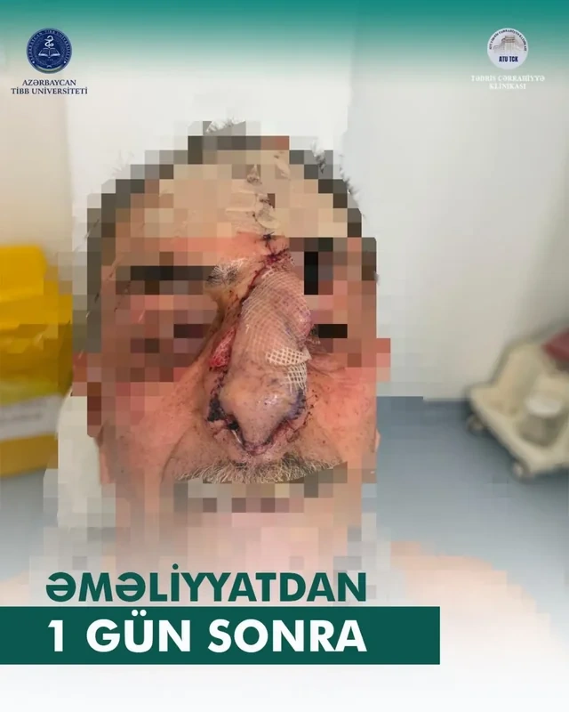 İt dişləməsi nəticəsində burnunu itirən xəstəyə yeni burun formalaşdırıldı - Azərbaycanda unikal əməliyyat - VİDEO - FOTO