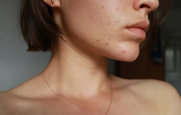 Yayda qadağan olunan kosmetik prosedurlar - Rusiyalı həkimdən vacib xəbərdarlıq