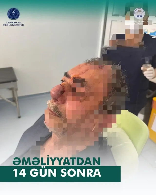İt dişləməsi nəticəsində burnunu itirən xəstəyə yeni burun formalaşdırıldı - Azərbaycanda unikal əməliyyat - VİDEO - FOTO