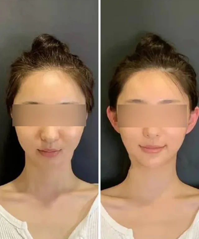 Asiyada yeni estetik çılğınlıq: "Elf qulaqları" trendə çevrilir - FOTO