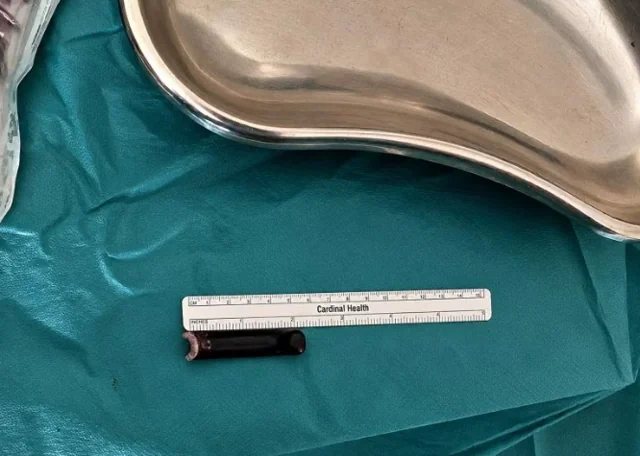 İtaliyada yeniyetmənin kürəyindən velosiped detalı çıxarıldı - Foto