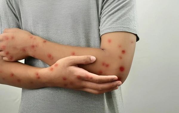 Meymunçiçəyi virusu dəyişir: Alimlər yeni mutasiya dalğasını aşkarladılar